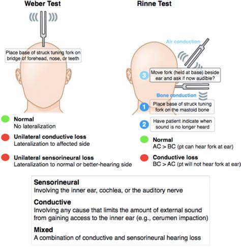 cerumen impaction rinne test|ncbi rinne test.